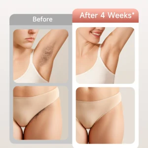 Hair Removal 9 energy levels epiladora laser with Acne treatment for Women’ - Thumbnail Image 4